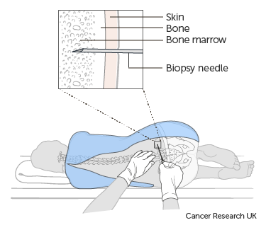 Diagram showing a bone marrow biopsy