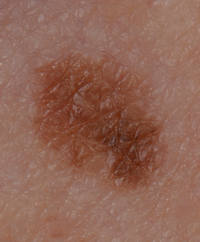 Melanoma from a mole that was once an even colour and shape but has now changed