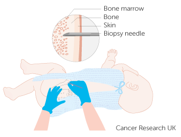 Diagram of a babys bone marrow test