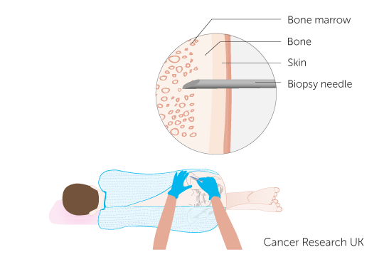 Diagram showing a childs bone marrow biopsy