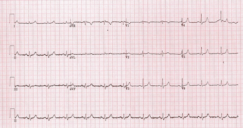 Diagram showing an ECG printed on paper