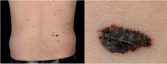 New, dark lesion on the skin proven to be a melanoma