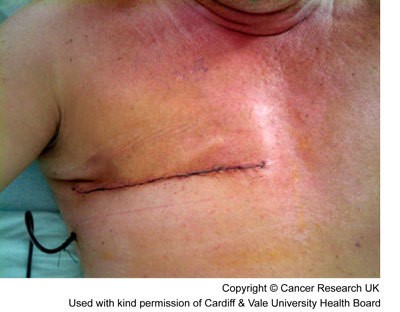 Photograph of a man 1 day after a mastectomy