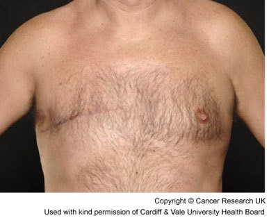 Photograph of a man 3 months after having a mastectomy for breast cancer.