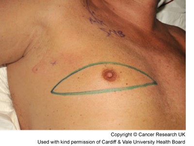 Photograph of the area to be removed during a mastectomy for this mans breast cancer