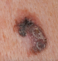 Photos of melanoma skin cancer | Melanoma | Cancer Research UK