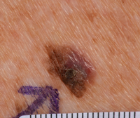 Melanoma that’s not developed from a mole and is starting to spread