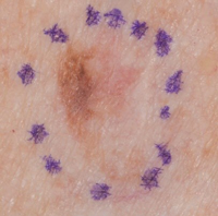 Melanoma that has developed from a changing area of the skin with irregular shape and colour