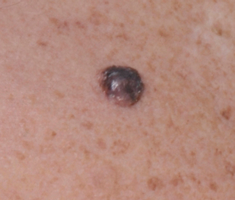 Photo of a nodular melanoma