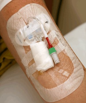 Photograph of a PICC line on an arm
