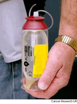 Photograph showing a continuous pressure pump for chemotherapy 