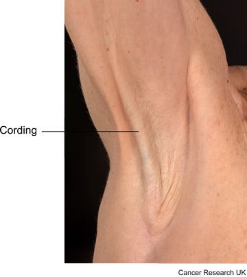 Picture showing cording in the armpit