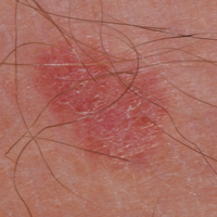 Photo of an amelanotic melanoma