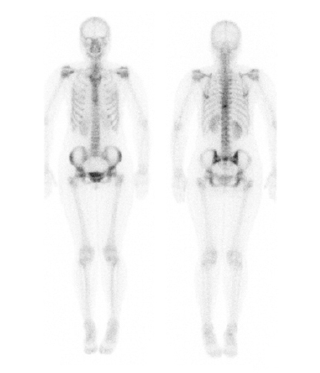 Diagram showing bone scan hot spots
