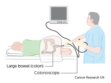 Diagram showing a colonoscopy