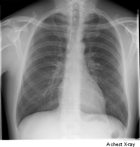 Photograph showing a chest x-ray 