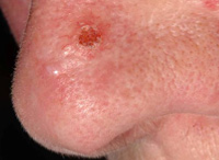 Photograph of morphoeic basal cell carcinoma