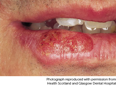 Photo showing cancer on lip