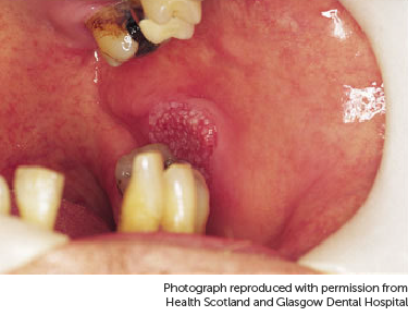Photo showing mouth cancer