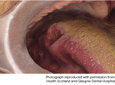 Photo showing cancer on the tongue