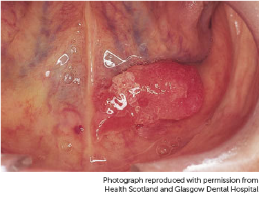 Photograph showing mouth cancer under tongue