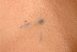 Photograph of radiotherapy tattoo marks