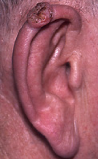 Photographs of squamous cell cancer on ear